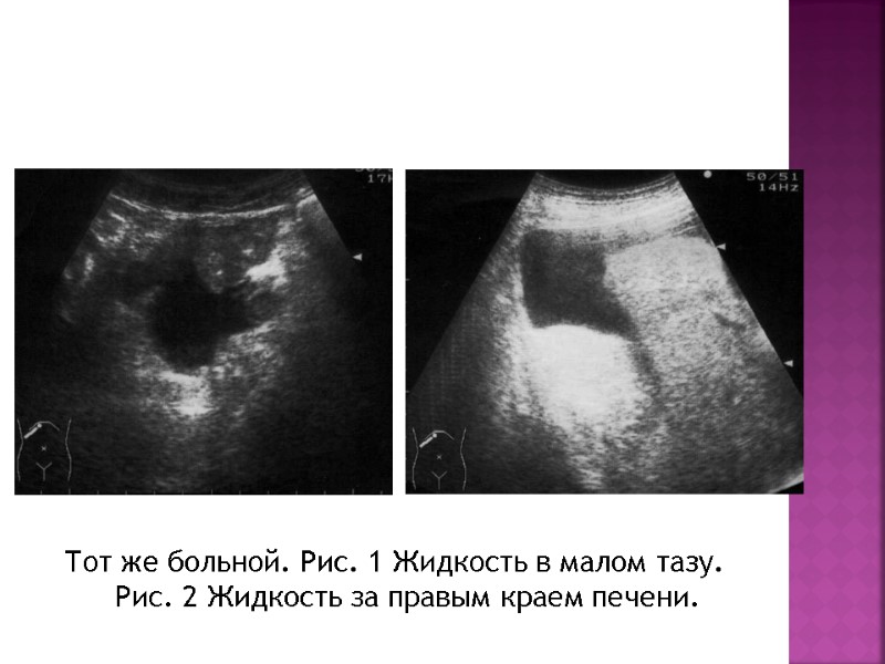 Тот же больной. Рис. 1 Жидкость в малом тазу. Рис. 2 Жидкость за правым